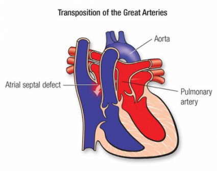Arterial switch procedure