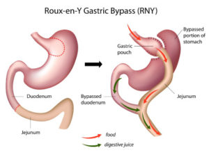 Gastric Bypass – Roux-En-Y