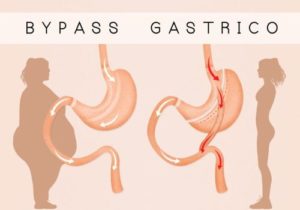 Roux-en-Y Gastric Bypass surgery outcome 