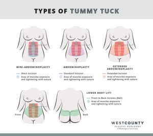 Types of tummy tuck