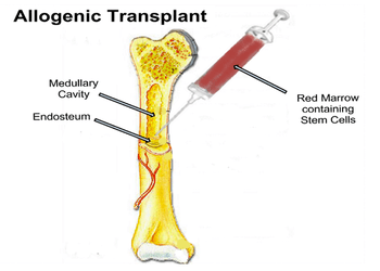 What Is Bone Marrow Transplant, Side Effects Of Bone Marrow Transplant