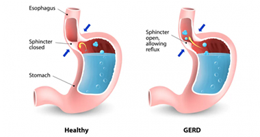 Anti Reflux Surgery (GERD)