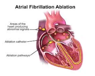 Atrial Fibrillation Surgery