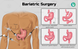 bariatric surgery