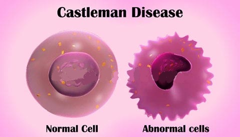 Castleman Disease Treatment