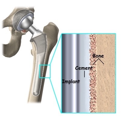 Cemented Total Hip Replacement