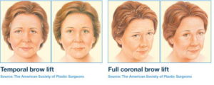 Coronal or Classical Brow Lift Surgery