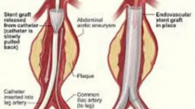 Endovascular aortic aneurysm repair (Aortic stent grafting)