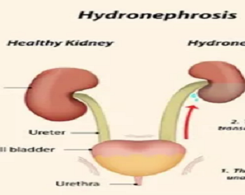 Hydronephrosis Treatment