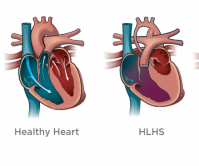 Hypoplastic Left Heart Syndrome (HLHS) Treatment