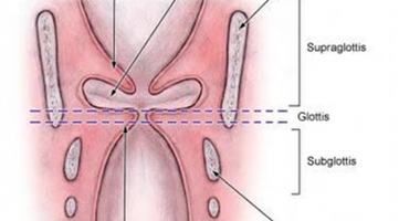Laryngeal Stenosis Treatment