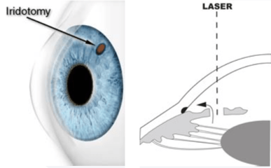Laser Iridotomy