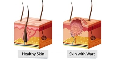 Nonmelanoma Skin Cancer