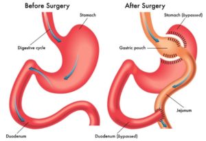Roux-en-Y gastric bypass surgery