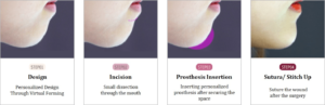 chin implant procedure