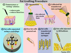 fat grafting procedure