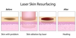 laser skin resurfacing procedure