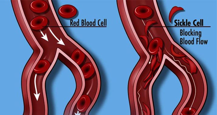 10 Indications of Sickle Cell Anemia