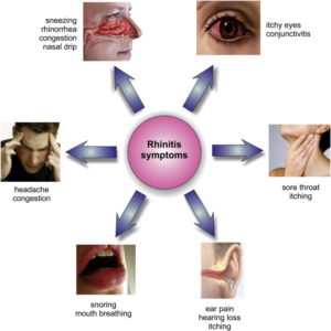 symptoms of allergic rhinitis