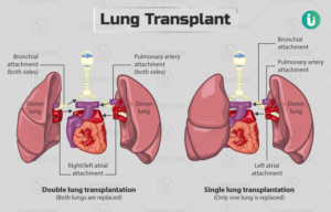 types of lung transplant