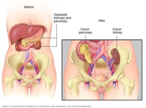 Combined Kidney-Pancreas Transplant.