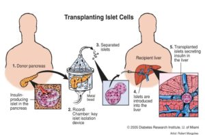 Pancreatic Islet Cells Transplant
