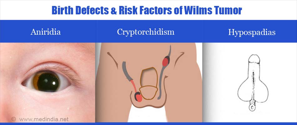 risk factors of Wilm’s tumor