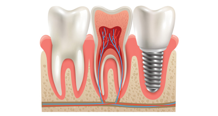 Dental Bone Grafting