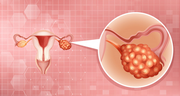 Medical Treatments For Fibroid