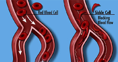 Lifestyle concerns of sickle cell anemia
