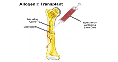 What is the preparation before Allogeneic Bone Marrow Transplant?