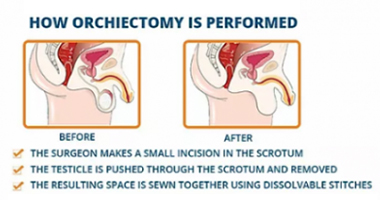 What are the Orchiectomy types and technique?