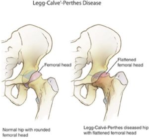 Legg-Calve-Perthes Disease