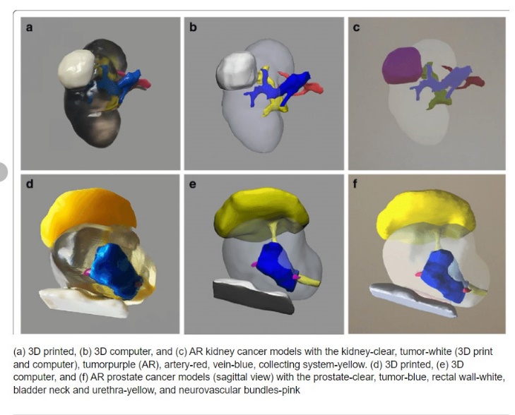 3D computer modeling of tumor 