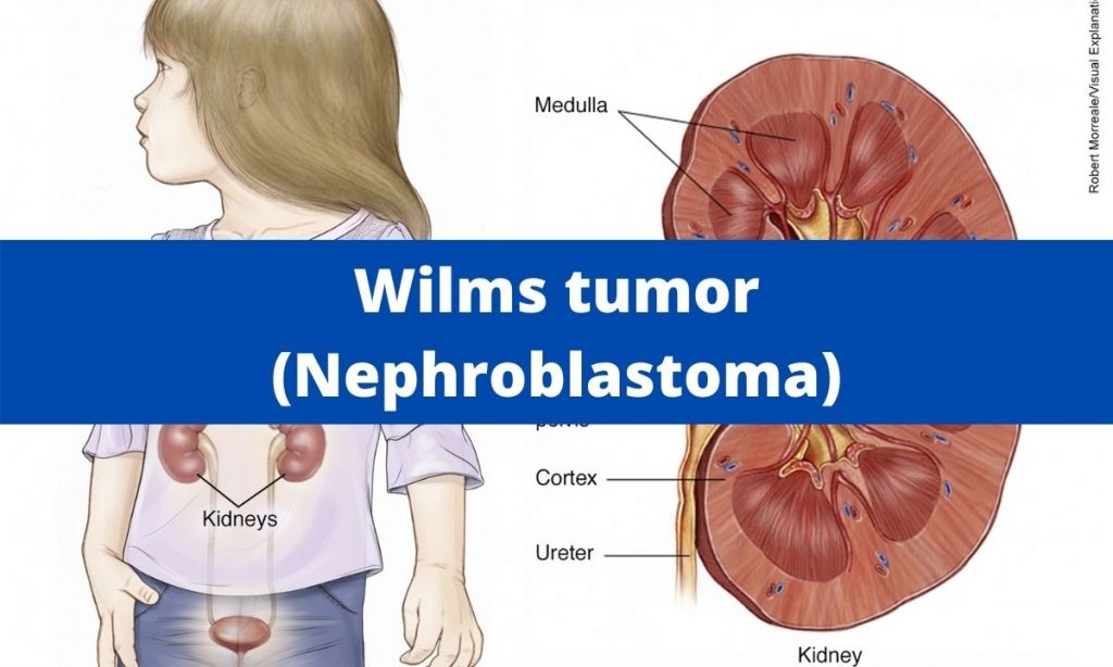 Nephroblastoma (Wilms Tumor)