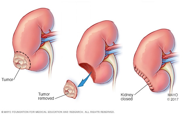 Surgical method kidney cancer treatment