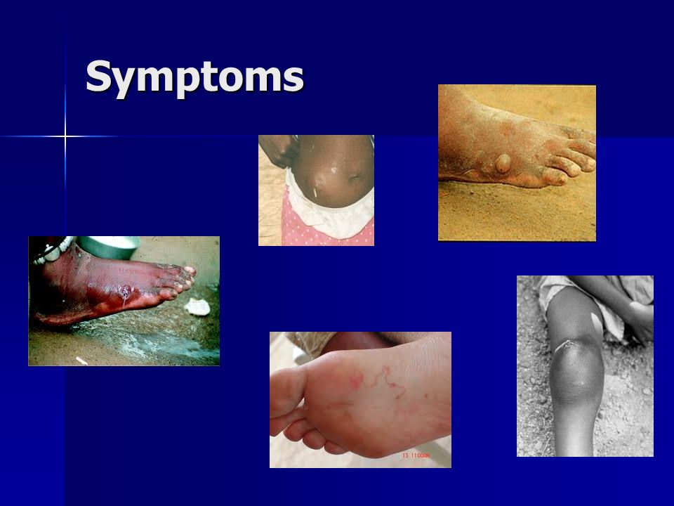 Dracunculiasis symptoms