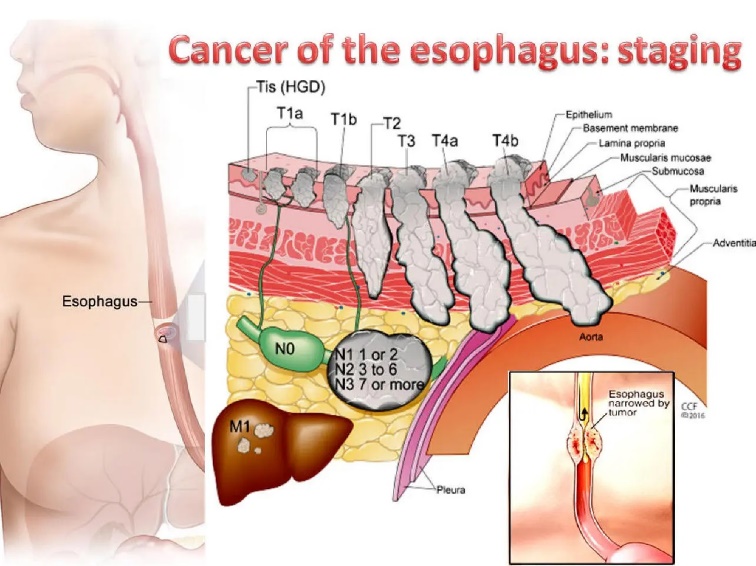 stages of oesophageal cancer