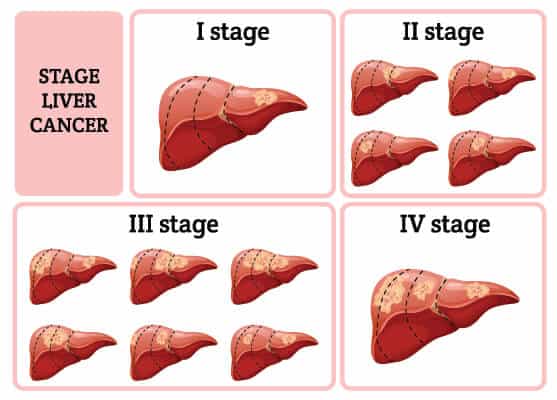 staging liver cancer