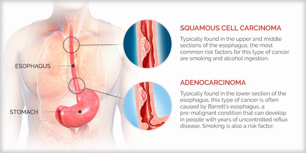 types of oesophageal cancer