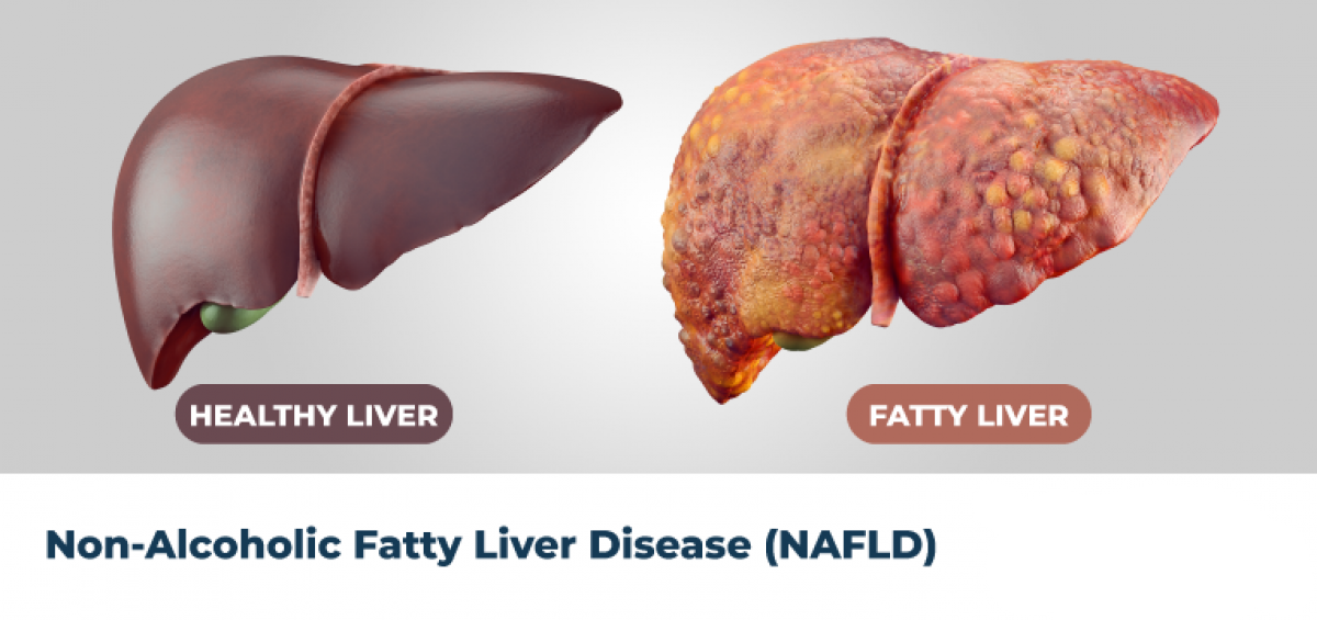 Nonalcoholic-Fatty-Liver-Disease