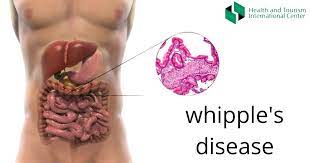 Whipple’s disease