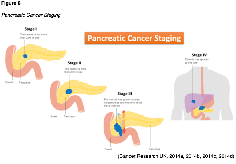 stages of pancreatic cancer
