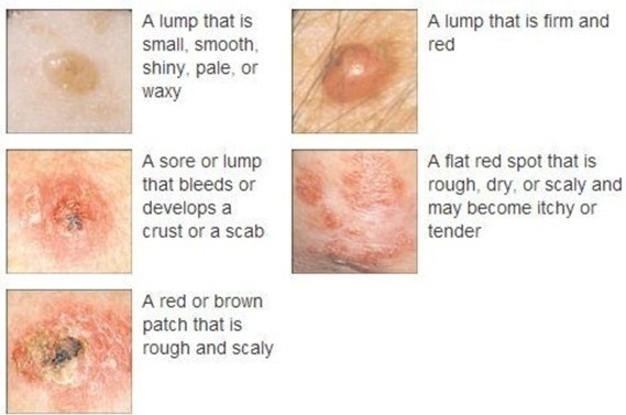 symptoms of skin cancer