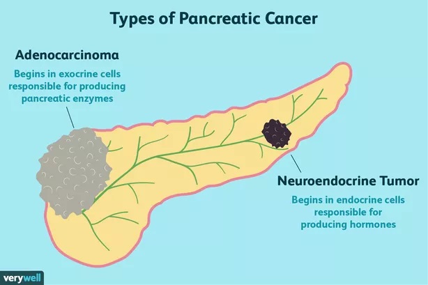types of pancreatic cancer